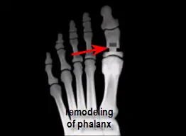 remodeling of great toe joint in Regnauld