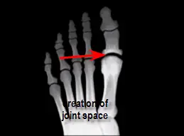 creation of joint space