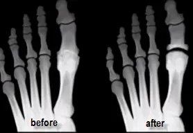 before and after in Regnauld procedure