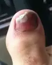 bleeding under toenail