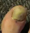 loose fungus nail