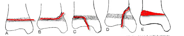 Salter-Harris-fractures