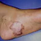 foot_scar