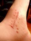 foot_incision_scar