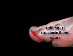 subungual exostosis