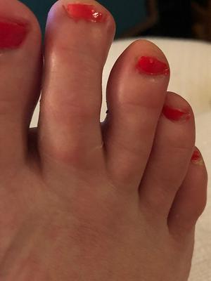 second toe is swollen (right foot)