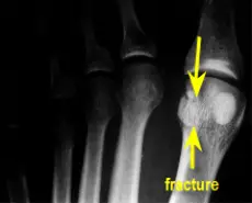 sesamoid fracture xray