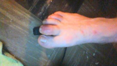 cellulitis second toe