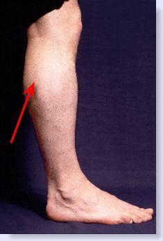 posterior shin splints