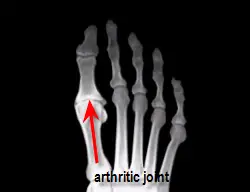 pre-operative degenerated joint of foot