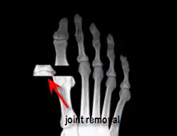 removal of arthritic joint