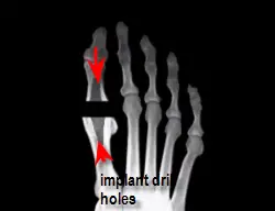 drill holes for Swanson total implant