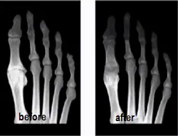 before and after Swanson total implant