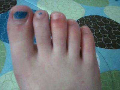 3rd, 4th, and 5th right toes swollen
