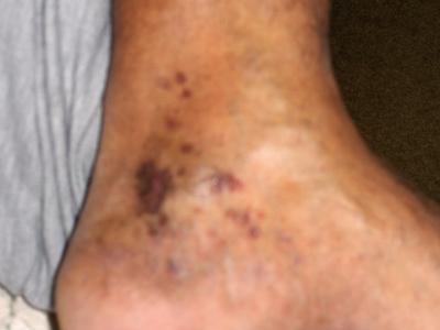 Pic of sores/spots on Ankle.