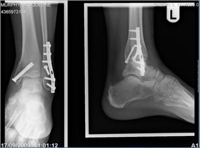 post operative  broken ankle with screws and plates