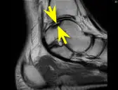 MRI of talar dome fracture