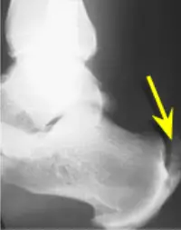 insertional calcific achilles tendinosis 