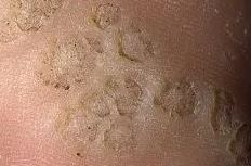 plantar wart