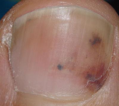 Spot toenail black under Black spot