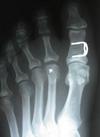 Akin osteotomy