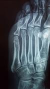 no healing six weeks post fifth metatarsal fracture