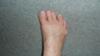  middle toe leans to the left