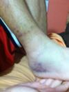 Freshly injured inversion sprain