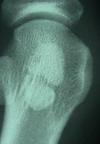 bipartate sesamoid