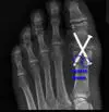 great toe joint fusion with possible cystic lesions