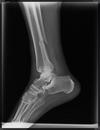 fractured fibula