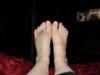 badly bruised foot secondary to trauma