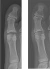 MTP Cartiva 1 mos & 3 mos Post-Op