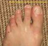 spreading of toes from Mortons neuroma