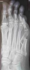 non union fifth metatarsal fracture