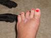 5 months post op for Mortons neuroma