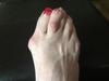 failed bunion surgery