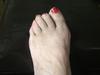 failed bunion and hammertoe surgery