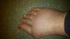 large bunion deformity