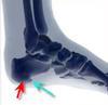 bone bruise or plantar fasciitis?