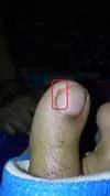 ingrown nail