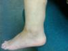 outer left ankle