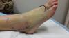 post op peroneal tendon repair and neuroma surgery