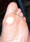 callus on bottom of foot