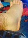 bruised heel seven weeks post trauma