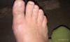 4 weeks post neuroma surgery