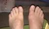 four weeks post neuroma surgery  right foot