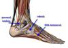 peroneal tendonitis or subluxed cuboid?