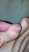 Pinky toe wart