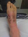 2 weeks post-op-Lisfranc surgery